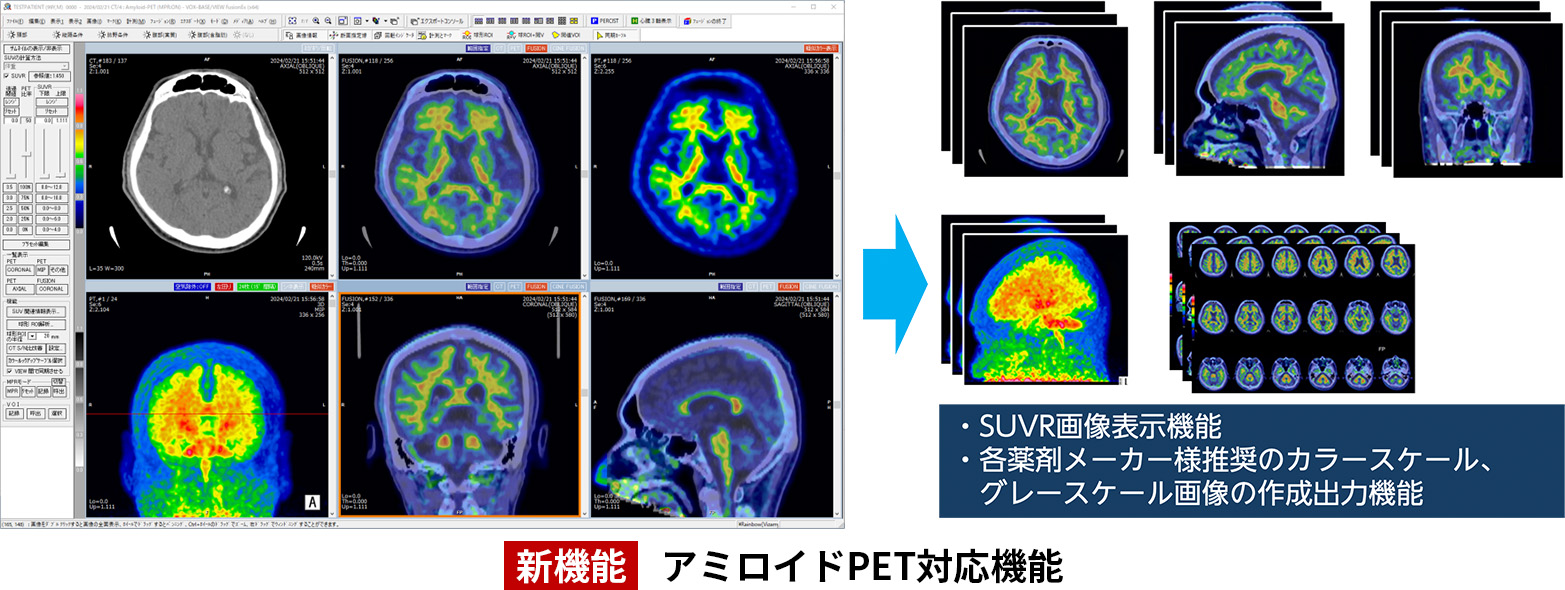 新機能 アミロイドPET対応機能 ・SUVR画像表示機能 ・各薬剤メーカー様推奨のカラースケール、グレースケール画像の作成出力機能​