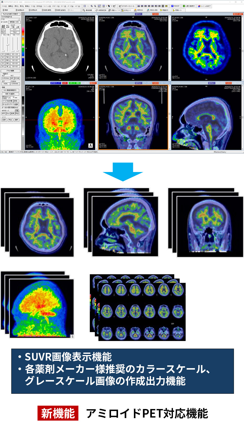 新機能 アミロイドPET対応機能 ・SUVR画像表示機能 ・各薬剤メーカー様推奨のカラースケール、グレースケール画像の作成出力機能​